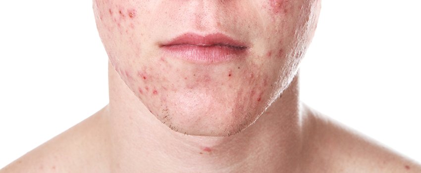 What Is Causing My Acne?
