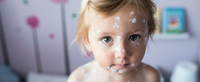 How Do I Know If It's Chickenpox?