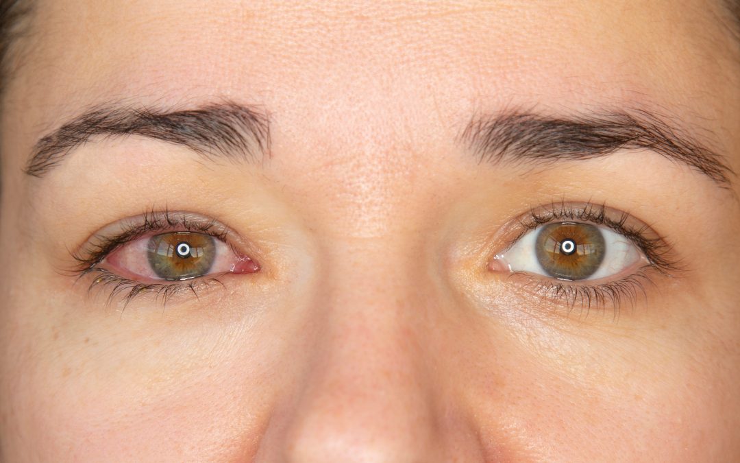 Do I have Pink Eye or a Stye?